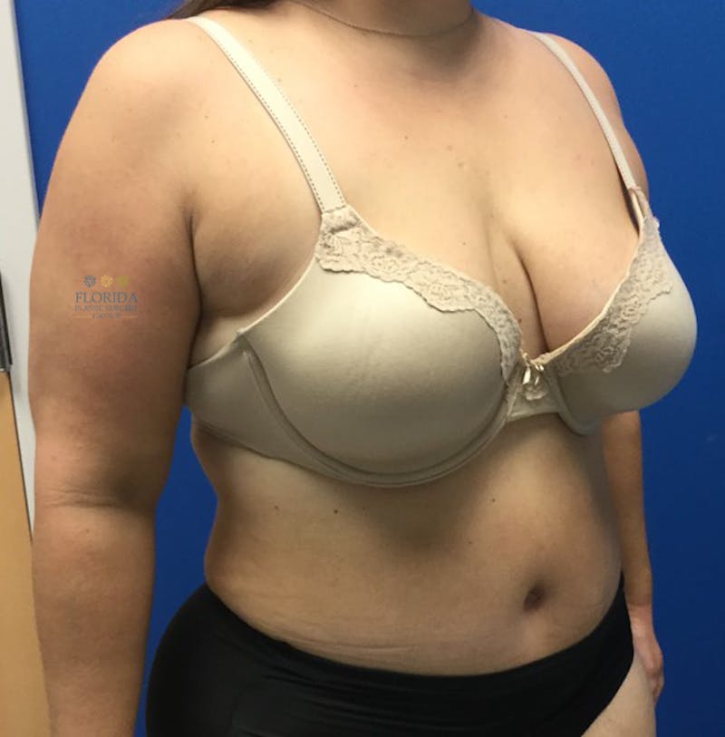 Abdominoplasty Before & After Gallery - Patient 154951992 - Image 6