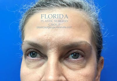 Blepharoplasty Before & After Gallery - Patient 154952000 - Image 2