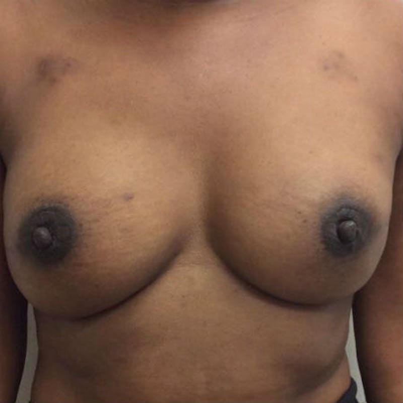 Nipple Sparing Breast Reconstruction Before & After Gallery - Patient 154951995 - Image 2