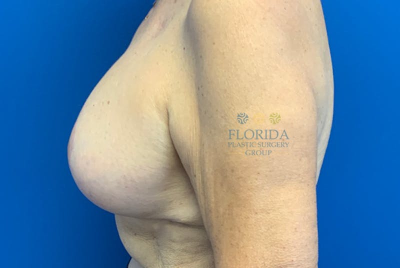 Tissue Expander Reconstruction Before & After Gallery - Patient 154952001 - Image 4