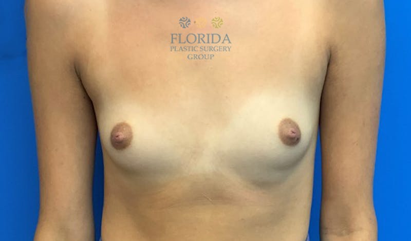 Silicone Breast Augmentation Before & After Gallery - Patient 154952003 - Image 1