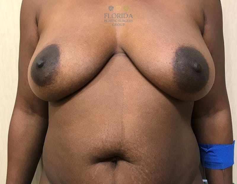Abdominoplasty Before & After Gallery - Patient 154951996 - Image 1