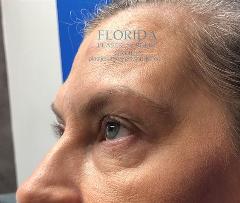 Blepharoplasty Before & After Gallery - Patient 154952000 - Image 3