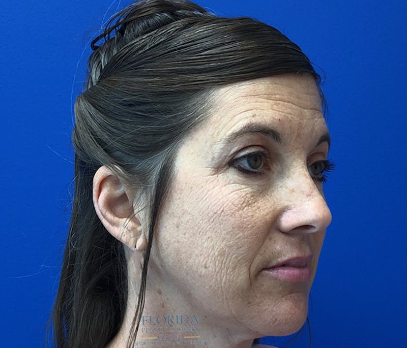 Facial Rejuvenation Before & After Gallery - Patient 154951998 - Image 3