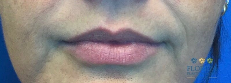 Injectables and Dermal Fillers Before & After Gallery - Patient 154951994 - Image 1