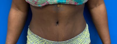 Abdominoplasty Before & After Gallery - Patient 154951996 - Image 2