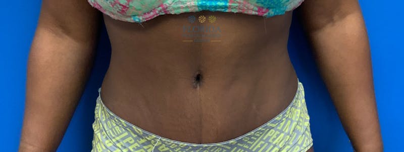 Abdominoplasty Before & After Gallery - Patient 154951996 - Image 2