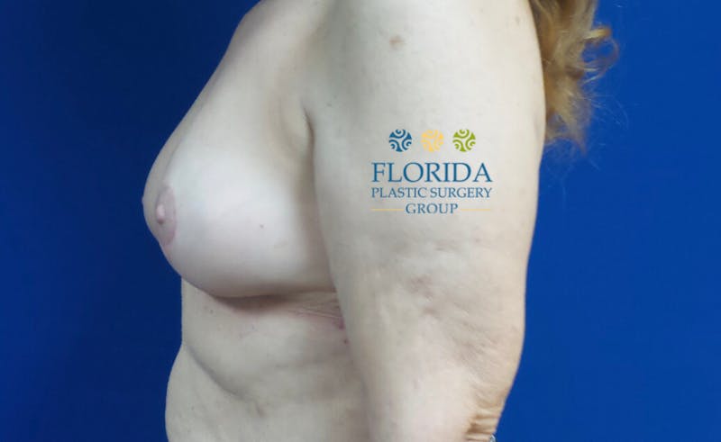 Breast Implant Removal Before & After Gallery - Patient 154951997 - Image 4