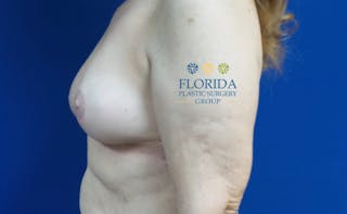 Breast Implant Removal Before & After Gallery - Patient 154951997 - Image 4