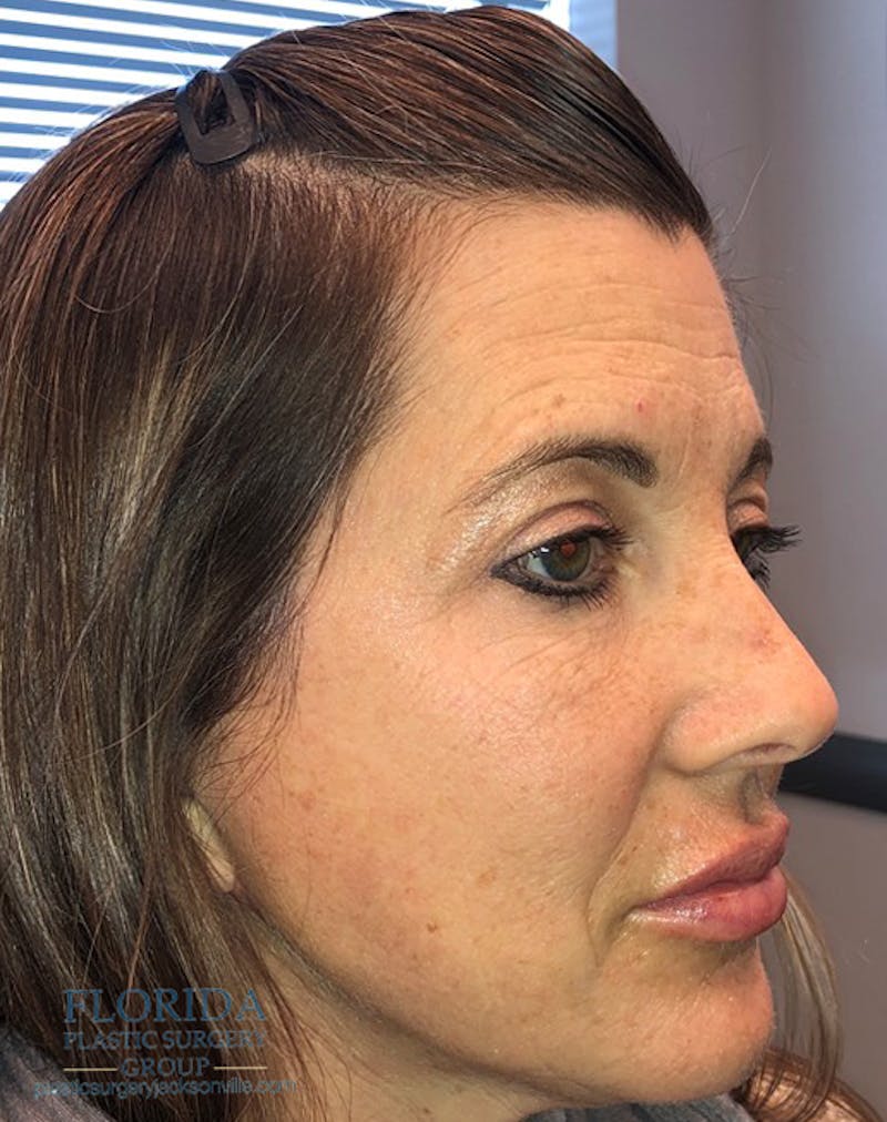 Facial Rejuvenation Before & After Gallery - Patient 154951998 - Image 4