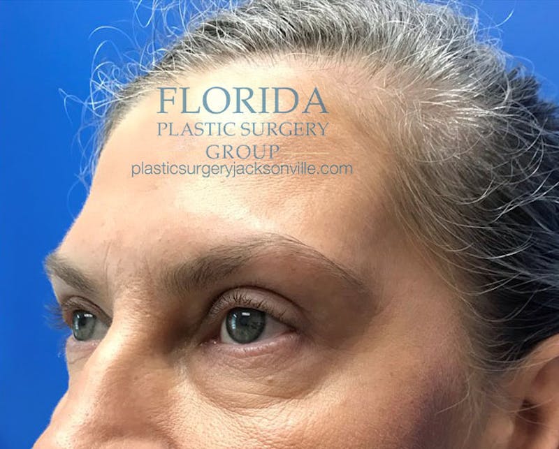 Blepharoplasty Before & After Gallery - Patient 154952000 - Image 4