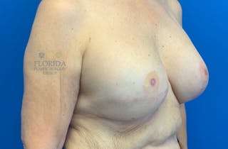 Tissue Expander Reconstruction Before & After Gallery - Patient 154952001 - Image 6