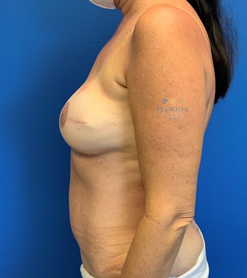 DIEP Flap Reconstruction Before & After Gallery - Patient 154952004 - Image 4