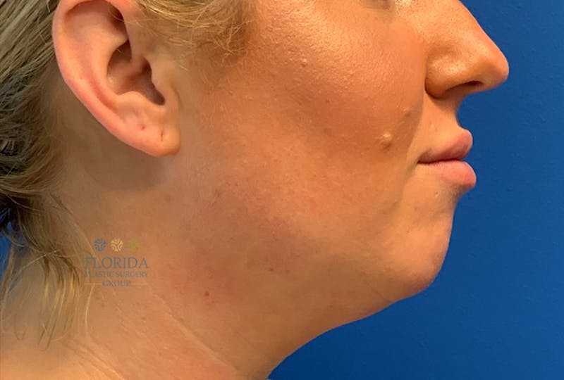 Facial Rejuvenation Before & After Gallery - Patient 154952023 - Image 1