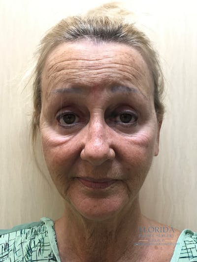 Blepharoplasty Before & After Gallery - Patient 154952034 - Image 1