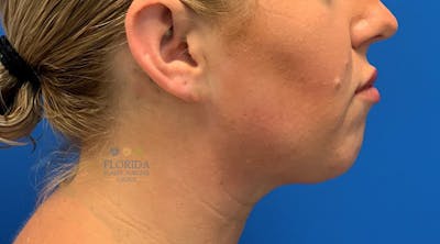 Facial Rejuvenation Before & After Gallery - Patient 154952023 - Image 2