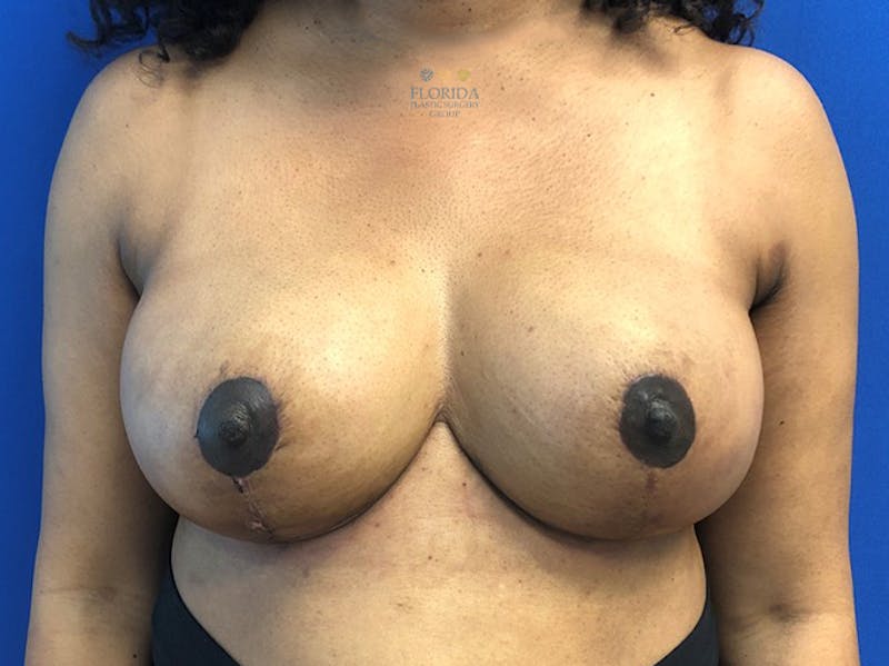 Breast Reduction Before & After Gallery - Patient 154952029 - Image 2