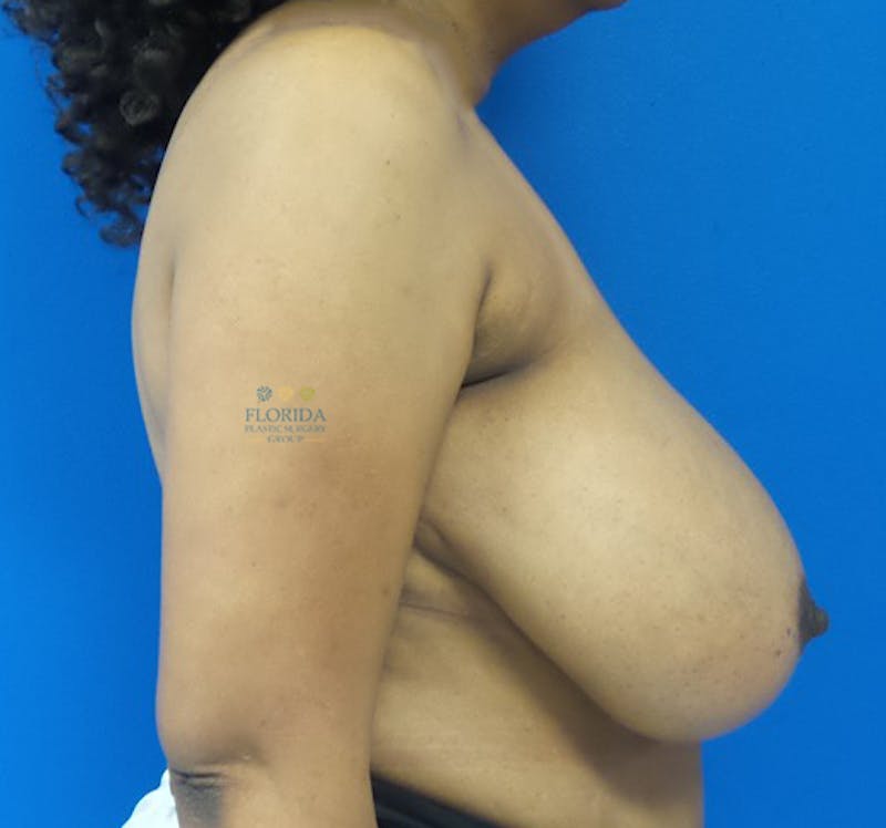 Breast Reduction Before & After Gallery - Patient 154952029 - Image 3