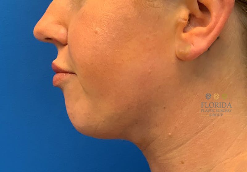 Facial Rejuvenation Before & After Gallery - Patient 154952023 - Image 4