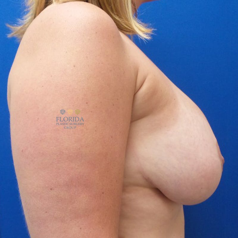 Breast Implant Removal Before & After Gallery - Patient 154952027 - Image 5