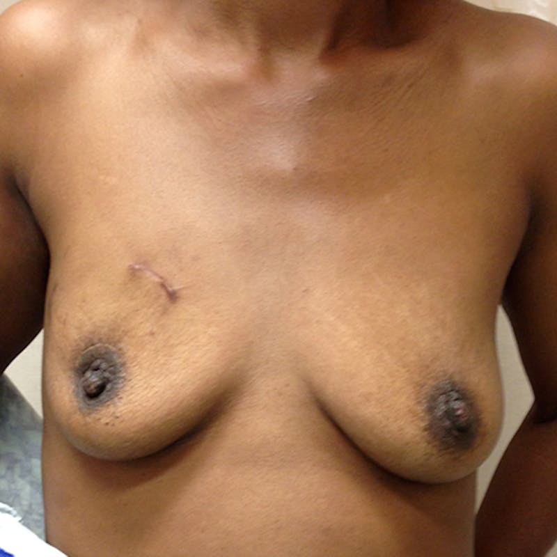 Nipple Sparing Breast Reconstruction Before & After Gallery - Patient 154952032 - Image 1