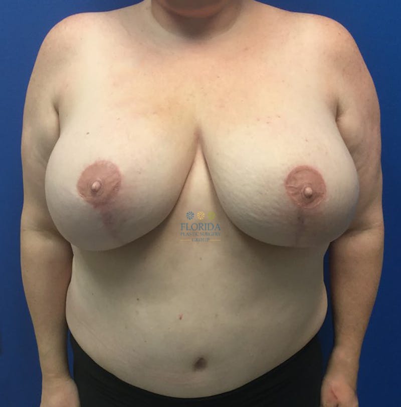 DIEP Flap Reconstruction Before & After Gallery - Patient 154952025 - Image 2