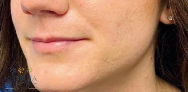 Injectables and Dermal Fillers Before & After Gallery - Patient 154952031 - Image 1