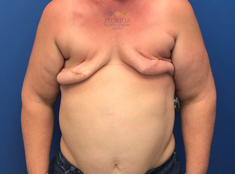 DIEP Flap Reconstruction Before & After Gallery - Patient 154952040 - Image 1
