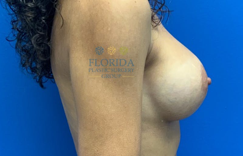 Silicone Breast Augmentation Before & After Gallery - Patient 154952030 - Image 6