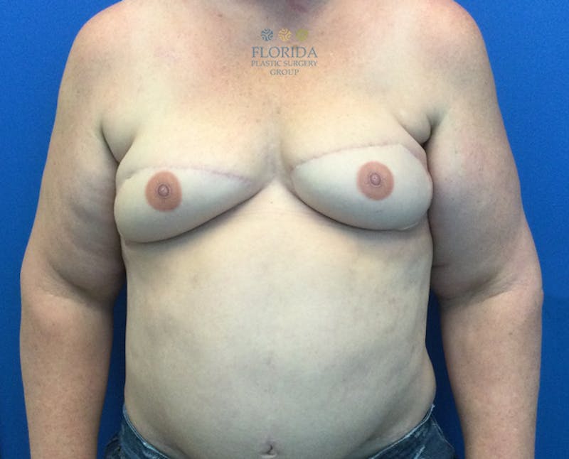 DIEP Flap Reconstruction Before & After Gallery - Patient 154952040 - Image 2