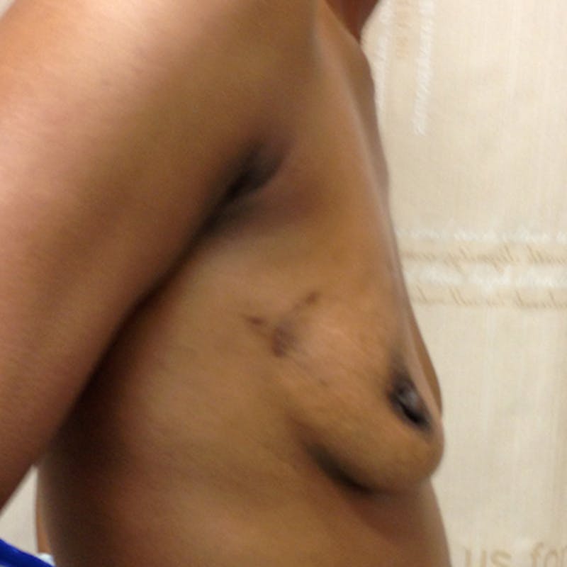 Nipple Sparing Breast Reconstruction Before & After Gallery - Patient 154952032 - Image 5