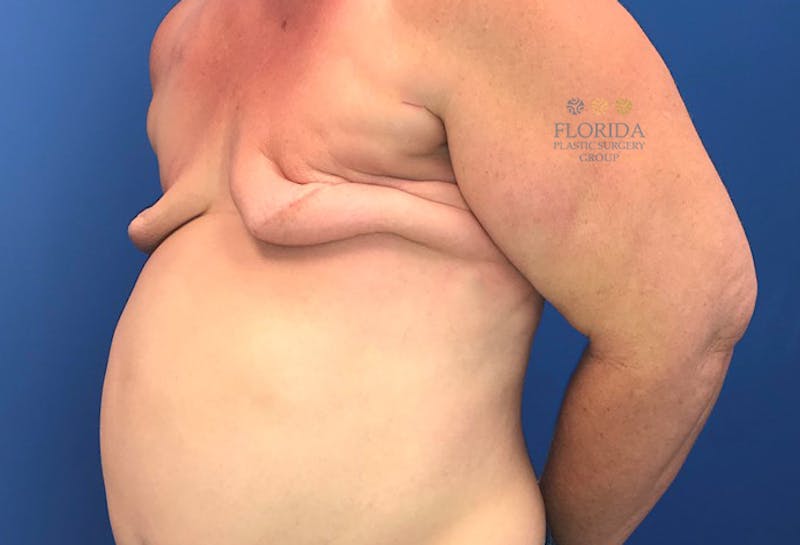 DIEP Flap Reconstruction Before & After Gallery - Patient 154952040 - Image 3