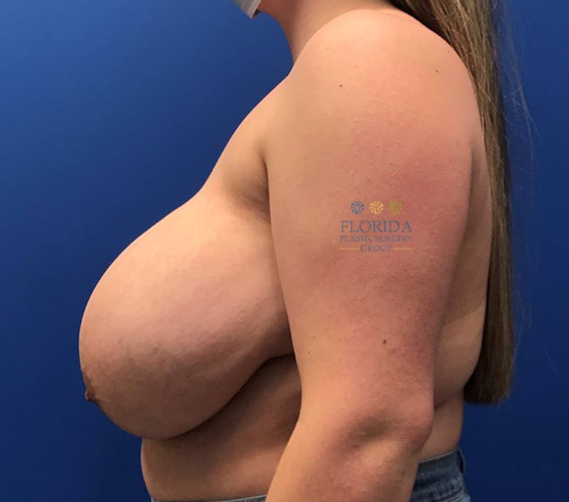 Breast Reduction Before & After Gallery - Patient 154952041 - Image 3