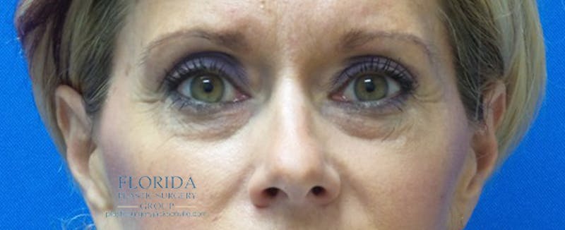 Blepharoplasty Before & After Gallery - Patient 154952042 - Image 1