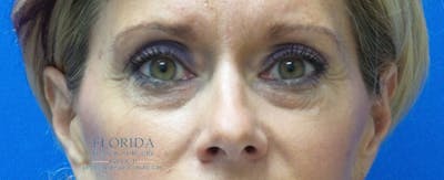 Blepharoplasty Before & After Gallery - Patient 154952042 - Image 1