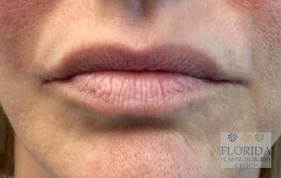 Injectables and Dermal Fillers Before & After Gallery - Patient 154952045 - Image 1