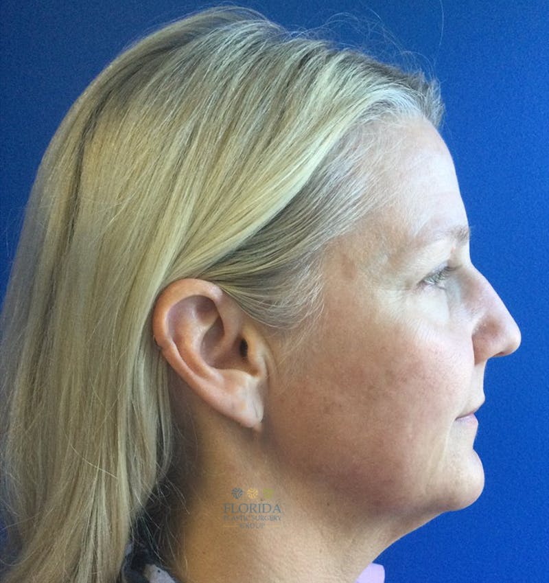 Facial Rejuvenation Before & After Gallery - Patient 154952037 - Image 5