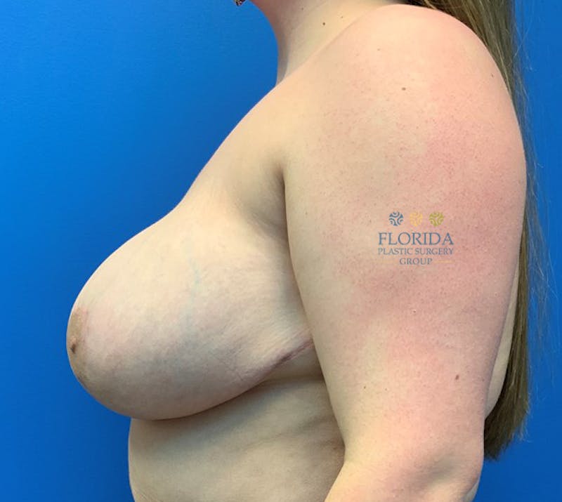 Breast Reduction Before & After Gallery - Patient 154952041 - Image 4