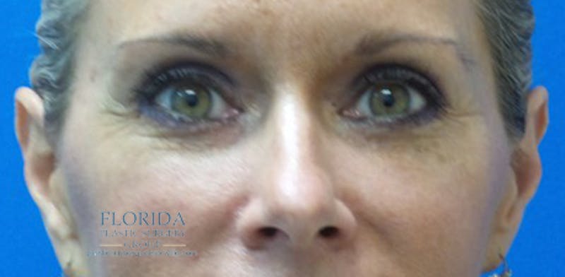 Blepharoplasty Before & After Gallery - Patient 154952042 - Image 2