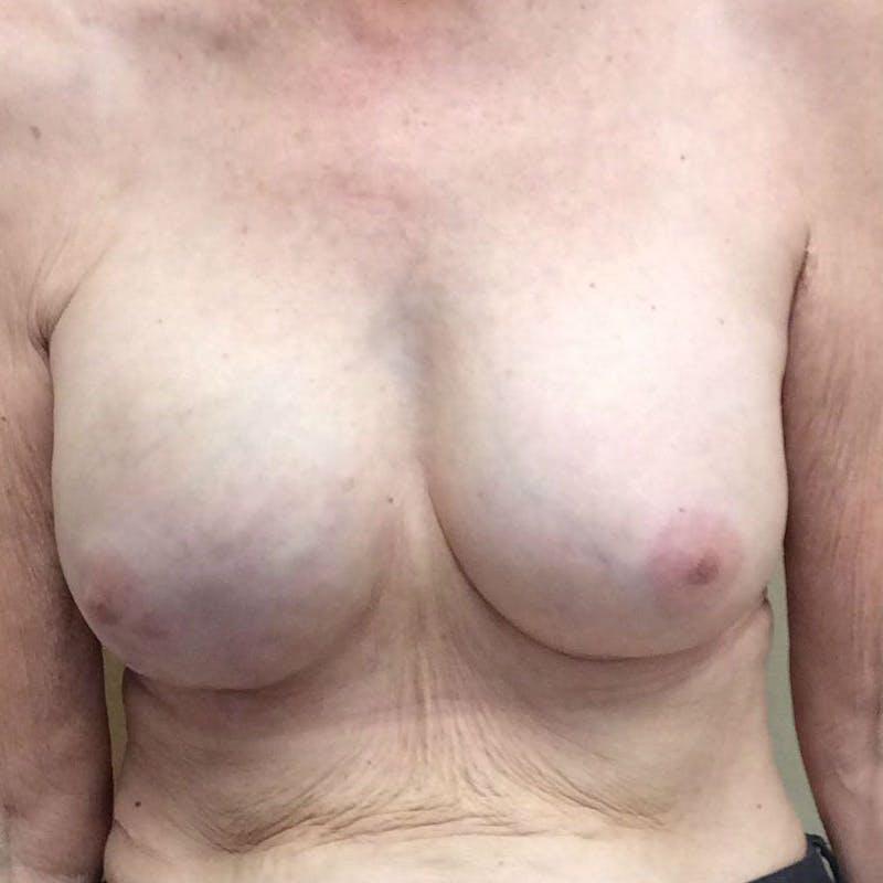 Nipple Sparing Breast Reconstruction Before & After Gallery - Patient 154952039 - Image 2