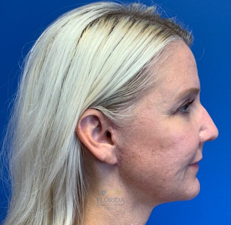 Facial Rejuvenation Before & After Gallery - Patient 154952037 - Image 6