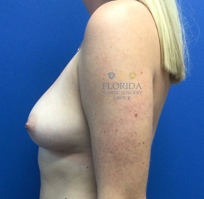 Silicone Breast Augmentation Before & After Gallery - Patient 154952043 - Image 5