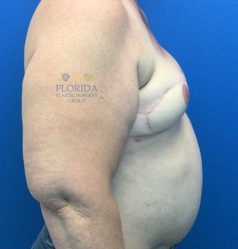 DIEP Flap Reconstruction Before & After Gallery - Patient 154952040 - Image 6