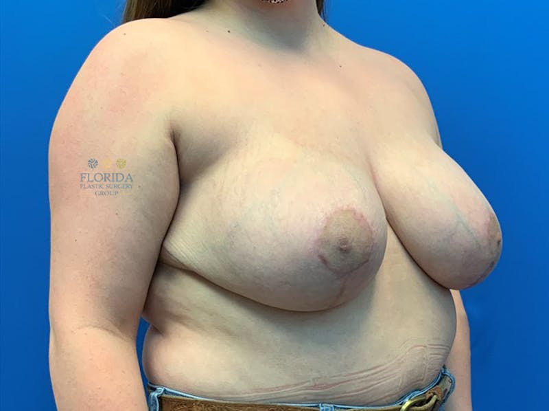 Breast Reduction Before & After Gallery - Patient 154952041 - Image 6