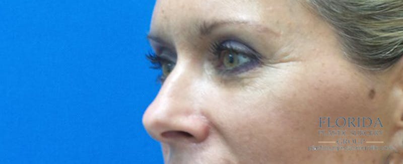 Blepharoplasty Before & After Gallery - Patient 154952042 - Image 4