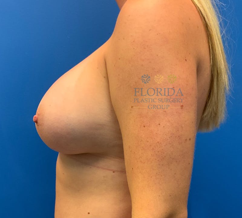 Silicone Breast Augmentation Before & After Gallery - Patient 154952043 - Image 6