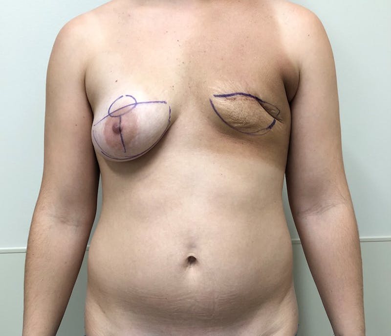 DIEP Flap Reconstruction Before & After Gallery - Patient 154952050 - Image 1