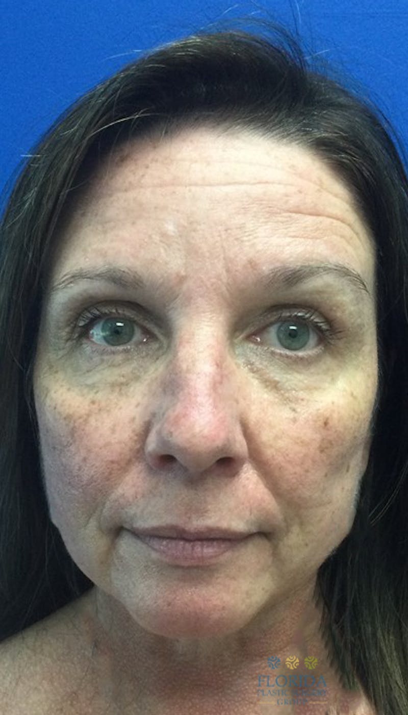 Blepharoplasty Before & After Gallery - Patient 154952048 - Image 1