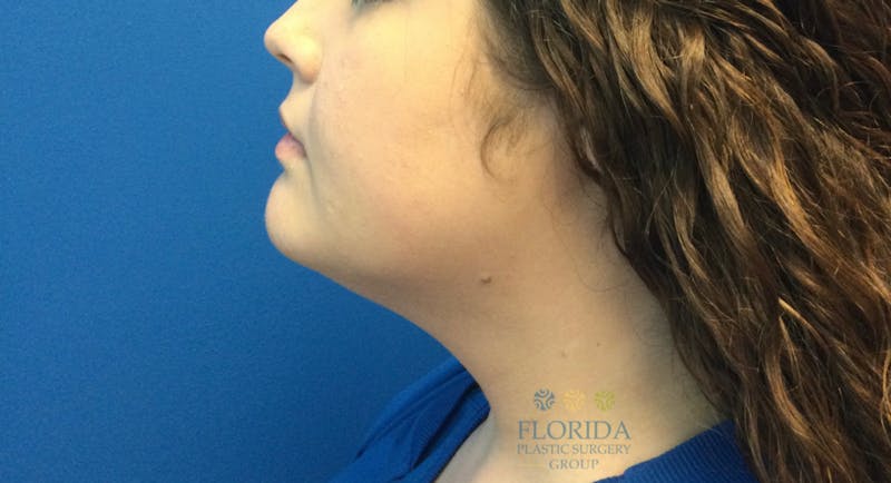 Facial Rejuvenation Before & After Gallery - Patient 154952086 - Image 3