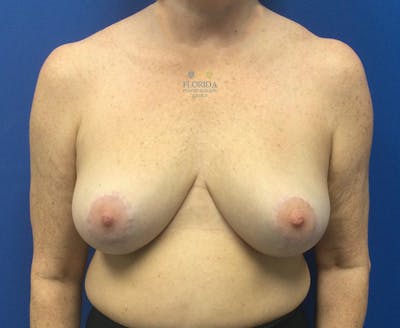Breast Reduction Before & After Gallery - Patient 154952069 - Image 2